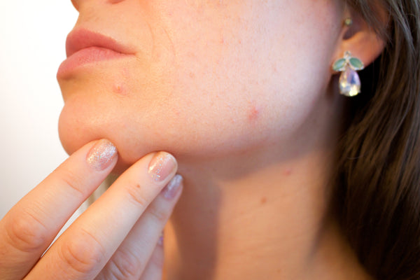 love your acne. but why?